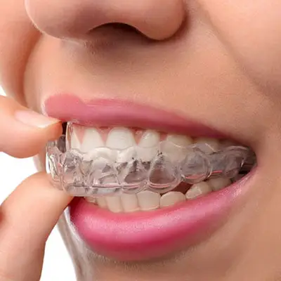 traitement orthodontique avec aligneurs invisibles